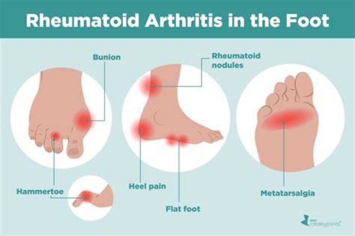 What does rheumatoid arthritis in toes feel like?