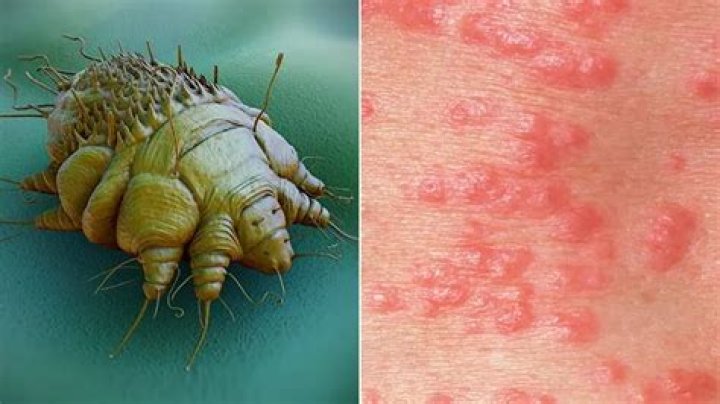 What does scabies look like when it first starts?