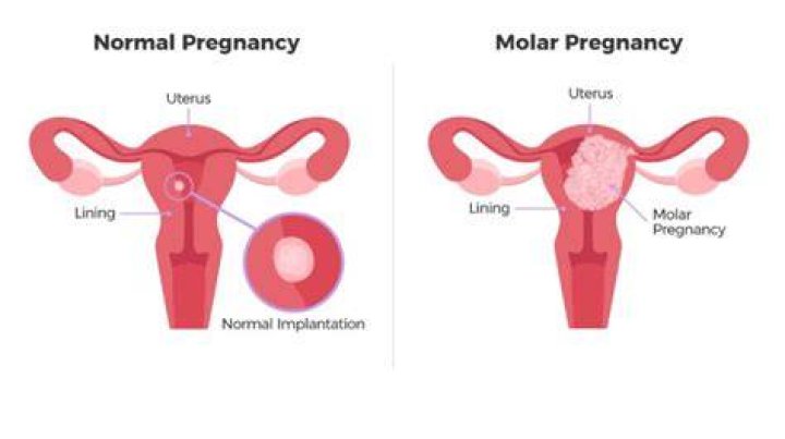 What happens after a partial molar pregnancy?