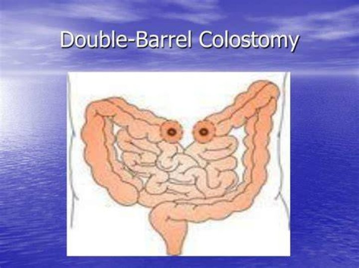 What is a double Barrelled colostomy?
