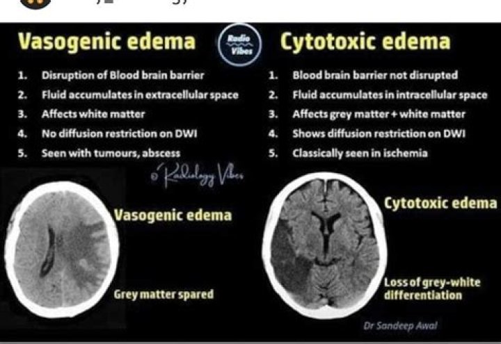 What is difference between cytotoxic and vasogenic edema?