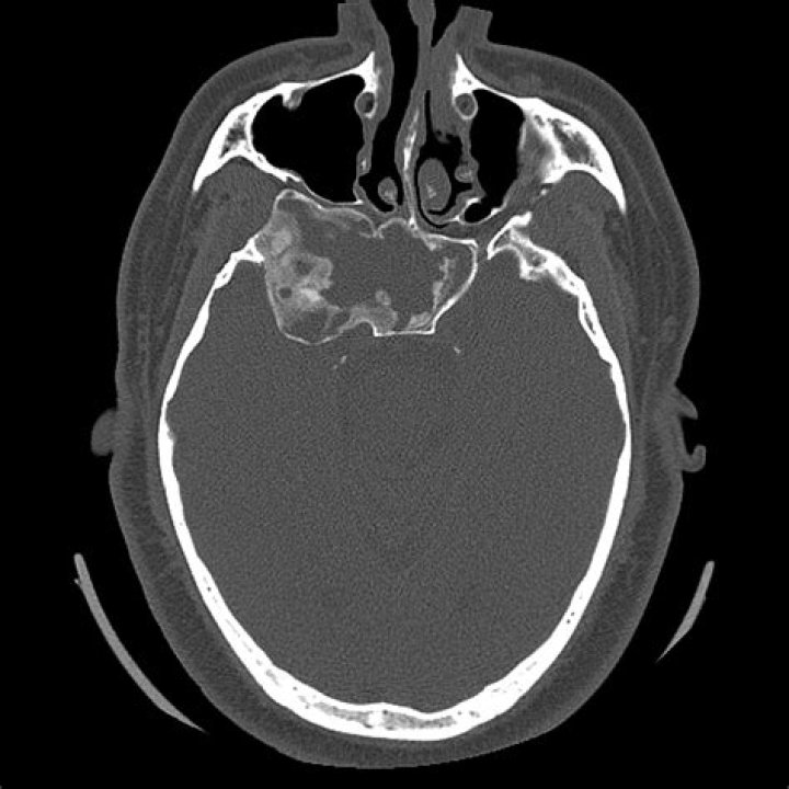 What is fibrous dysplasia of the skull?