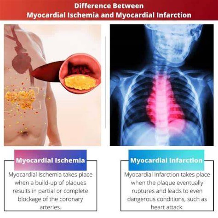 What is the difference between a heart attack and a myocardial infarction?