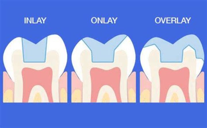 What is the difference between inlay and overlay?