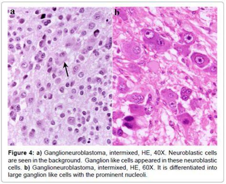What is the difference between neuroblastoma and Ganglioneuroblastoma?
