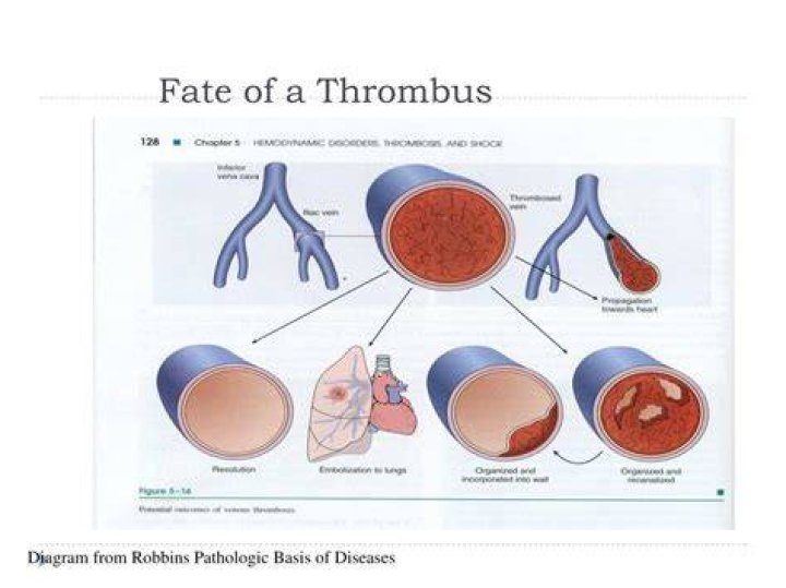 What is the fate of the thrombus?
