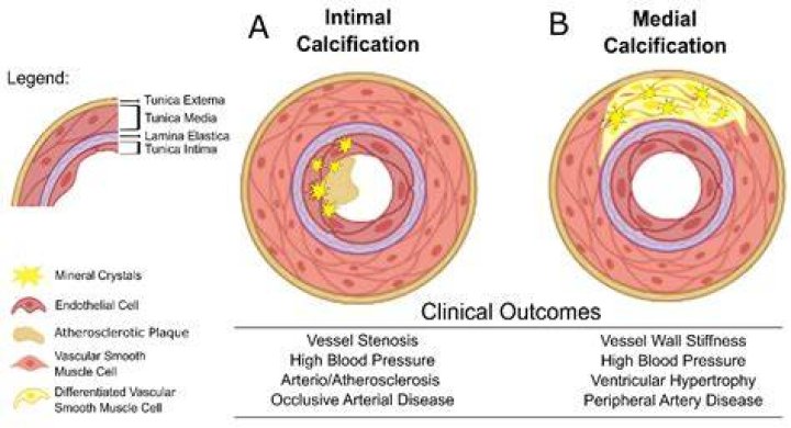 What is the treatment for vascular calcification?