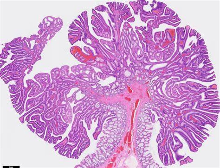 What is Tubulovillous adenoma?