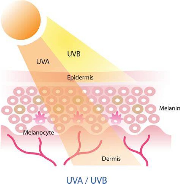 What is UVB induced?
