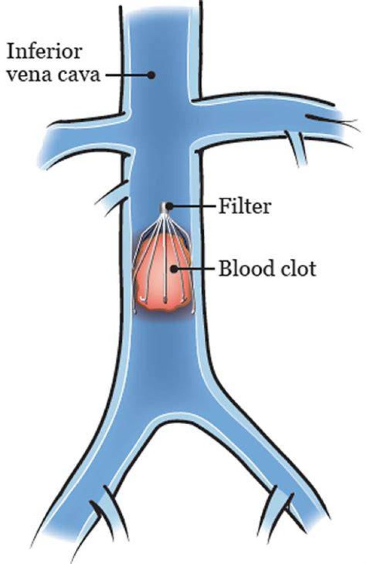 What is vena cava interruption?