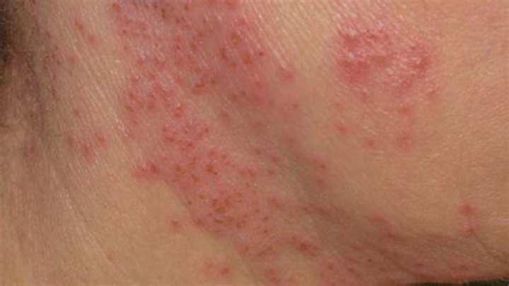What kind of rash has little blisters?