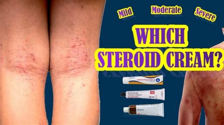 Which steroid cream is best for eczema?